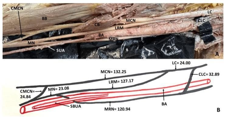 This educational composite presents a clinical photograph of a cadaveric dissection (A) and a corresponding schematic diagram (B) of the right upper limb, illustrating rare neurovascular variations in the arm. The content identifies a low formation of the median nerve (MN), occurring in the distal half of the arm by the union of the lateral root (LRM) and medial root (MRN). Anatomical highlights include a communicating branch (CMCN) between the musculocutaneous nerve (MCN) and the median nerve, and another communication (CLC) between the lateral cord (LC) and the medial root. A significant vascular anomaly is shown: a superficial brachioulnar artery (SBUA/SUA) originating high from the brachial artery (BA) and passing directly through the loop formed by the two roots of the median nerve. The schematic (B) provides precise morphometric measurements in millimeters for each neural segment. This material serves as a reference for anatomical variations in the brachial plexus and arterial supply of the upper extremity, relevant for surgical planning and gross anatomy education.