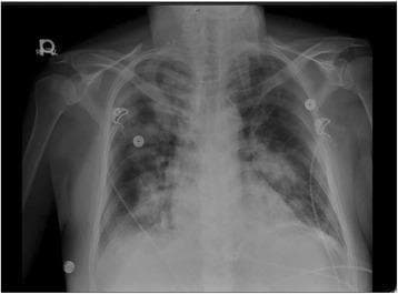 A portable anteroposterior (AP) chest X-ray demonstrating a clinical state of pulmonary edema. The image shows bilateral, patchy reticular opacities with a predominant distribution in the hilar and perihilar regions of both lungs. There is no evidence of cardiomegaly, as the cardiothoracic ratio appears within normal limits. The bony thorax, including the clavicles and ribs, and the great vessel silhouettes appear unremarkable. External medical artifacts, including ECG leads and wires, are visible across the chest wall. The visual findings are consistent with pulmonary congestion, often associated with a depressed ejection fraction or acute heart failure. This diagnostic image serves as a teaching tool for recognizing interstitial and alveolar patterns in the context of cardiovascular and respiratory medicine.