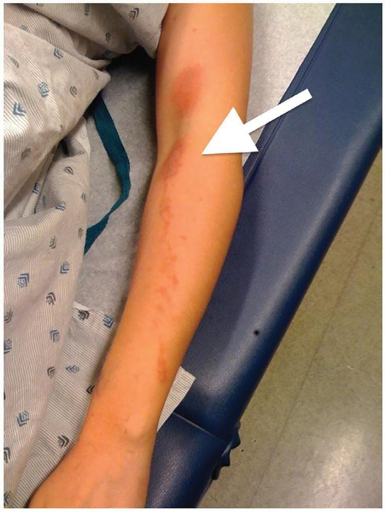 This clinical photograph displays a dermatological presentation on the upper extremity of a patient. The image features a prominent erythematous rash with a distinctive linear and splash-like distribution extending along the forearm. A white arrow points to the antecubital fossa (flexor surface of the elbow), highlighting a key area where the rash demonstrates evidence of transfer or contact dermatitis, often seen when an irritant or allergen is spread across skin surfaces during flexion. The morphology of the lesions includes confluent red patches and scattered vesicles or small blisters, which are characteristic of an acute inflammatory response. Such visual findings are highly suggestive of allergic contact dermatitis, specifically phytophotodermatitis or exposure to Toxicodendron species (poison ivy/oak), where linear streaks result from the direct brushing of plant oils against the skin. This material is useful for medical education in dermatology and primary care for identifying patterns of contact-mediated skin eruptions.