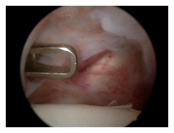This diagnostic image is an intraoperative clinical photograph showing an arthroscopic view of an anterior shoulder capsule release. The visual field displays the internal shoulder joint environment, characterized by fibrous, pinkish-red vascularized tissue representing the joint capsule. A metallic, silver-colored surgical instrument with a U-shaped distal end is positioned on the left side of the frame, currently interacting with the capsular tissue. A linear incision or 'release' is visible in the anterior capsule, appearing as a dark, longitudinal disruption in the tissue fibers with slightly retracted edges. The procedure aims to increase joint mobility, typically in cases of adhesive capsulitis, by surgically dividing tightened ligaments. The image demonstrates the surgical technique of interval capsule incision while avoiding damage to the adjacent subscapularis tendon. This content is suitable for orthopedic surgical education, illustrating arthroscopic anatomy and procedural landmarks.