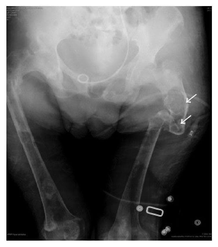 Anteroposterior pelvic X-ray demonstrating advanced skeletal manifestations of severe primary hyperparathyroidism, specifically osteitis fibrosa cystica. The imaging shows diffuse demineralization and widespread osteopenia with a significant reduction in cortical thickness across the pelvis and bilateral femurs. Multiple well-circumscribed, radiolucent cystic lesions and expansive 'brown tumors' are visible, notably in the right proximal femur (indicated by white arrows). There is evidence of a pathological fracture in the femoral neck and distortion of the pelvic girdle architecture. The long bones show subperiosteal resorption and intramedullary cystic changes. A medical drain or catheter is visible overlying the lower abdomen and pelvis, and external monitoring equipment is present on the lower limbs. This diagnostic image illustrates the end-stage metabolic bone disease associated with untreated parathyroid adenomas, highlighting the risks of fracture and profound bone resorption in this clinical context.