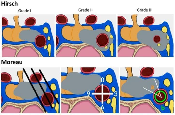 Educational medical diagram illustrating two radiological classification systems for cavernous sinus (CS) invasion by sellar tumors, such as pituitary adenomas, shown in coronal section. The top panel depicts the Hirsch classification (Grades I-III): Grade I shows the tumor (grey) partially touching the internal carotid artery (ICA); Grade II shows total ICA encasement without luminal narrowing; and Grade III shows encasement with significant ICA diameter reduction (stenosis). The bottom panel illustrates the Moreau criteria for assessing CS invasion: the first frame shows three intercarotid lines (medial, median, and lateral) intersecting the ICA and tumor; the second frame demonstrates the subdivision of the cavernous ICA into quadrants (0, 3, 6, 9 o'clock positions); and the third frame uses angular analysis (angle 'a') to quantify the degree of tumor-ICA contact. Key anatomical landmarks include the pituitary gland (orange), sphenoid sinus (pink), and the cavernous sinus venous spaces (blue/yellow).