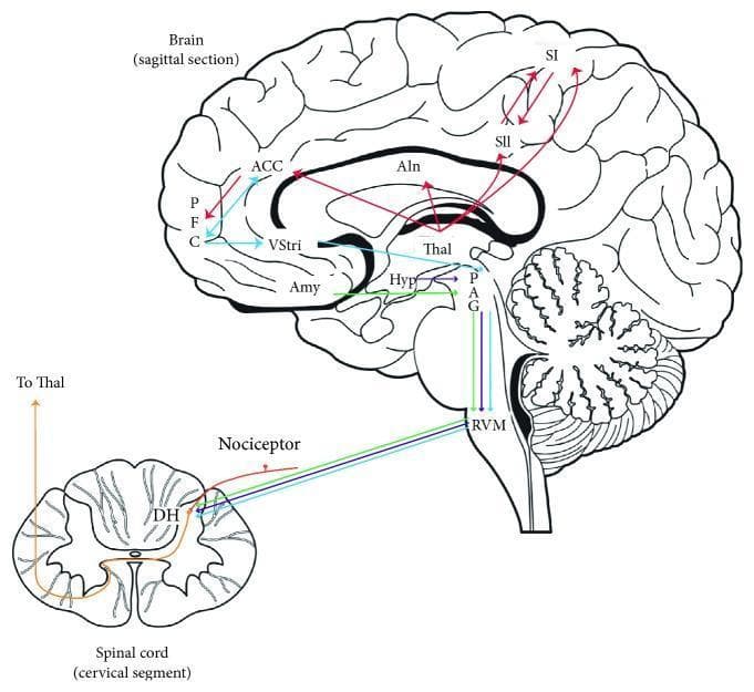 A medical anatomical diagram illustrating the human pain modulatory system through a sagittal section of the brain and a transverse section of the cervical spinal cord. The diagram highlights the ascending and descending pathways involved in pain processing. Nociceptive input is shown entering the dorsal horn (DH) and ascending via the spinothalamic tract to the thalamus (Thal). From the thalamus, pathways diverge into the sensory-discriminative system (primary and secondary somatosensory cortices: SI, SII) and the affective-motivational system (anterior cingulate cortex: ACC, prefrontal cortex: PFC, and anterior insula: AIn). Subcortical involvement is indicated by connections to the hypothalamus (Hyp), amygdala (Amy), and ventral striatum (VStri). The descending inhibitory control system is depicted originating from the periaqueductal gray (PAG) and rostroventromedial medulla (RVM), which project back to the dorsal horn to modulate spinal nociceptive transmission. This visualization serves as an educational resource for neuroanatomy and pain physiology.