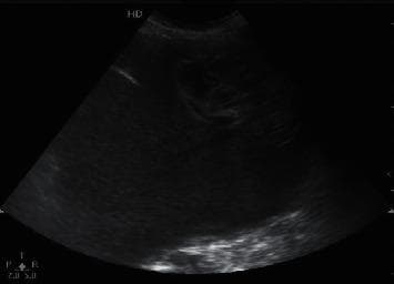 This diagnostic ultrasound image depicts a large, complex cystic mass located within the pelvic and lower abdominal cavity of a 38-year-old female patient. The mass demonstrates characteristic features of a multi-loculated ovarian cyst, including internal septations that divide the structure into multiple compartments. Key echogenic findings include a heterogenous internal environment with dense punctate or spot echoes dispersed throughout the fluid-filled regions, indicating the presence of debris, hemorrhage, or high-viscosity content. Additionally, certain areas of the mass exhibit vesicle-like aggregations. The image also captures evidence of peritoneal effusion, characterized by poor sound transmission and dense echoes within the free fluid. This clinical imaging is used for the preoperative assessment of ovarian pathology, illustrating complex internal morphology that aids in differentiating between simple and complex gynecological cysts.