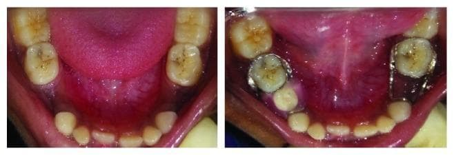 This intraoral clinical photograph provides a comparative view of the mandibular arch in a pediatric patient, showing preoperative (left) and immediate postoperative (right) states. The primary focus is on two different space-maintaining interventions following the premature loss of deciduous molars. In the left mandibular quadrant (tooth 74 region), a conventional fixed band and loop space maintainer is installed, consisting of a stainless steel band around the second deciduous molar and a simple wire loop extending mesially to maintain the mesiodistal dimension. In the right mandibular quadrant (tooth 84 region), a functional band and loop space maintainer is visible. This modified appliance features a stainless steel band and wire loop integrated with an aesthetic acrylic pontic (artificial tooth) designed to restore occlusal function and prevent supra-eruption of opposing teeth while maintaining space. The images illustrate key concepts in pediatric dentistry and interceptive orthodontics, specifically the management of arch length and masticatory function during the transition from primary to permanent dentition.