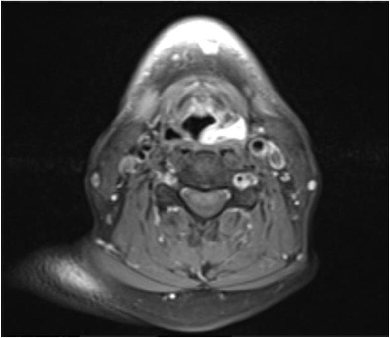 This diagnostic image is an axial cross-section of the upper neck obtained via Magnetic Resonance Imaging (MRI). The scan focuses on the hypopharynx and larynx at the level of the piriform fossae. A prominent, well-defined pathological lesion is visualized within the left piriform fossa. On this post-contrast T1-weighted sequence, the lesion demonstrates intense, bright enhancement compared to the surrounding soft tissues, indicating high vascularity or contrast uptake. The lesion occupies the left piriform sinus space, causing partial obliteration of the anatomical recess. Surrounding anatomical structures include the cervical vertebrae posteriorly, the laryngeal airway centrally, and the major neurovascular bundles of the neck laterally. The clinical significance of these findings relates to the identification of a soft tissue mass in the hypopharynx, which in this context corresponds to a lipomatous hamartoma. The image is intended for intermediate to advanced medical learners focusing on radiology, otorhinolaryngology, and head and neck pathology.