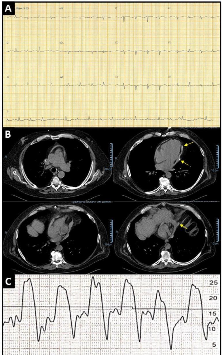 This composite educational image illustrates diagnostic findings for constrictive pericarditis through three distinct modalities. Panel A displays a 12-lead electrocardiogram (ECG) demonstrating a sinus rhythm with diffuse low voltage of the QRS complexes, a classic sign of impaired cardiac conduction due to pericardial thickening or effusion. Panel B presents four axial views from a non-contrast chest CT scan, showing a notably thickened pericardium with high-attenuation hyperdense foci (yellow arrows) consistent with pericardial calcification. Panel C provides a pressure tracing from cardiac catheterization, showing the characteristic 'square root sign' (dip-and-plateau configuration) and equalization of atrial and ventricular diastolic pressures. Collectively, these images teach the hallmark cardiovascular manifestations of constrictive pericarditis, including structural calcification, electrical voltage reduction, and hemodynamic alterations in ventricular filling. The content is suitable for medical education regarding restrictive versus constrictive cardiomyopathy diagnostic protocols.