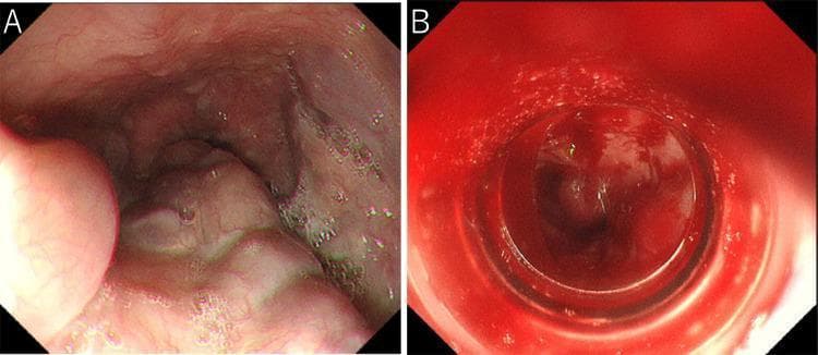 A pair of endoscopic clinical photographs illustrating the esophagus before and after endoscopic variceal ligation (EVL). Image A shows moderately enlarged, beads-like (F2) esophageal varices protruding into the esophageal lumen. The varices appear as dilated, tortuous, and nodular-shaped venous structures with an irregular surface, typical of severe portal hypertension. Image B demonstrates the immediate post-EVL state, characterized by significant oozing hemorrhage and fresh blood pooling within the lumen, which obscures the underlying mucosal details. This side-by-side comparison highlights the clinical presentation of esophageal varices and the potential complication of immediate post-procedural bleeding during or after band ligation. The educational focus is on identifying variceal morphology and recognizing complications of therapeutic endoscopy in the management of portal hypertension.