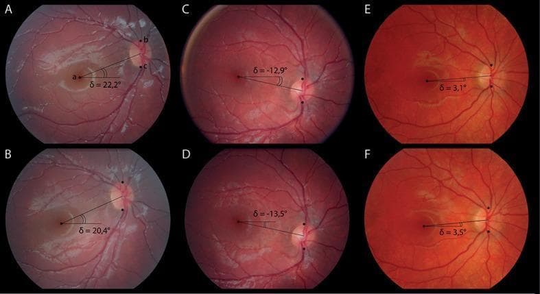A series of six fundus photographs (A-F) demonstrating the measurement of the disc-foveal angle (δ) in various clinical scenarios, including V-pattern strabismus, healthy eyes, and A-pattern strabismus. Each image displays the retinal vasculature, optic disc, and fovea. Overlay lines and annotations show the geometric relationship between the center of the fovea and the optic nerve head relative to a horizontal reference line. Images A and B show a positive disc-foveal angle of approximately 20-22°, indicating significant excyclotorsion common in V-pattern strabismus. Images C and D display a negative angle (approximately -13°), representing incyclotorsion where the fovea is positioned higher than the optic disc. Images E and F show a near-neutral positive angle (approximately 3°), suggesting minor excyclotorsion. These images illustrate the use of fundus photography to objectively quantify ocular torsion, which is critical in diagnosing and managing cyclovertical strabismus and motility disorders.