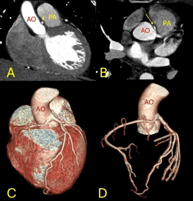 A multi-panel clinical diagnostic image set demonstrating an anomalous origin of the right coronary artery (RCA) from the left coronary sinus. Panels A and B are CT angiography (CTA) images in coronal and axial planes, respectively, showing the interarterial course of the RCA. Yellow arrows highlight the vessel passing between the aorta (AO) and the pulmonary artery (PA). Panels C and D provide three-dimensional colored volume renderings of the cardiac anatomy and coronary arterial tree. These renderings illustrate the spatial relationship of the AO and the origin of the coronary arteries, highlighting the 'malignant' course of the anomalous vessel as it exits the aorta and traverses the space between the major outflow tracts. The imagery is intended for advanced medical education regarding congenital coronary anomalies, specifically the risk of compression associated with interarterial pathways. Labels 'AO' and 'PA' identify the primary vascular landmarks, while panels C and D emphasize the superficial and deep branching patterns of the coronary circulation.
