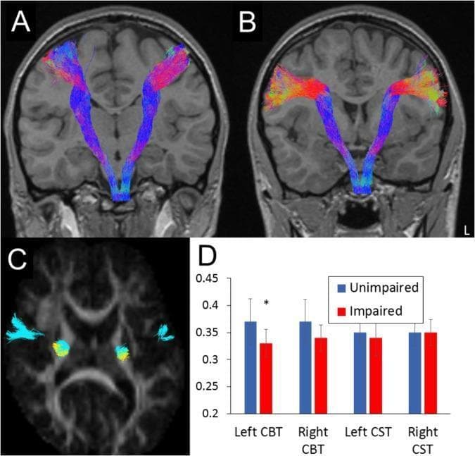 This composite educational graphic focuses on neuroimaging and diffusion tensor imaging (DTI) tractography of motor pathways. Panels A and B present coronal T1-weighted MRI scans with overlaid white matter reconstructions. Panel A depicts the corticospinal tract (CST), primarily in blue, showing its descent from the motor cortex through the internal capsule toward the brainstem. Panel B illustrates the dorsal corticobulbar tract (CBT), displaying a more varied color spectrum (red, yellow, and blue) representing different fiber orientations. Panel C provides an axial cross-section demonstrating the spatial relationship and partial overlap of the CBT (cyan) and CST (yellow) at the level of the posterior limb of the internal capsule. Panel D is a bar graph comparing fractional anisotropy (FA) values between 'Unimpaired' and 'Oromotor-Impaired' groups, highlighting a statistically significant reduction in FA within the left dorsal CBT for the impaired group. This material is designed for advanced medical education in neuroanatomy and radiology, specifically illustrating motor tract topography and the clinical significance of fiber integrity in oromotor function.