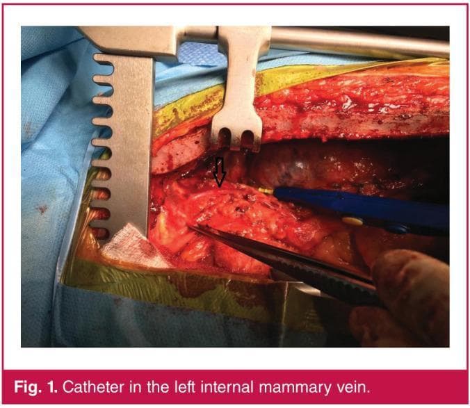 This clinical photograph shows an intra-operative view of a surgical field during a cardiothoracic procedure, specifically depicting the dissection of the left internal mammary artery (LIMA) area. A large, metallic self-retaining retractor is used to provide exposure of the surgical site, with yellow adhesive surgical drapes visible at the wound margins. The anatomical focus is the internal mammary vascular bundle. A black arrow points to a triple-lumen central venous catheter that has been inadvertently malpositioned into the left internal mammary vein (LIMV) rather than following the intended internal jugular pathway. Visible surgical instruments include a blue electrosurgical (cautery) pencil, surgical scissors, and a toothed forceps/pickup held by a surgical gloved hand, which are being used to navigate the red, fibrous, and adipose-rich tissues of the thoracic wall. This image serves as a clinical teaching example for identifying catheter malposition and verifying vascular integrity during open surgical dissection.