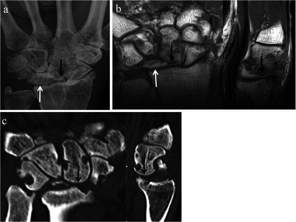 This composite of diagnostic images illustrates the late stages of Scapholunate Advanced Collapse (SLAC) wrist. Panel (a) is a posteroanterior (PA) radiograph showing marked carpal instability and degeneration. Panel (b) features coronal and sagittal T1-weighted MRI views, and panel (c) shows coronal and sagittal CT reformats. The primary diagnostic features highlighted across all modalities include significant proximal migration of the capitate (indicated by black arrows) and ulnar displacement of the lunate (white arrows). These structural shifts indicate a loss of carpal height and severe disruption of the normal ligamentous support. Extensive osteoarthritic changes are evident, characterized by joint space narrowing, subchondral sclerosis, and osteophyte formation, particularly at the radioscaphoid and capitolunate articulations. This advanced pattern of arthropathy typically follows chronic scapholunate ligament dissociation, leading to the characteristic 'collapse' of the carpus and progressive joint destruction.