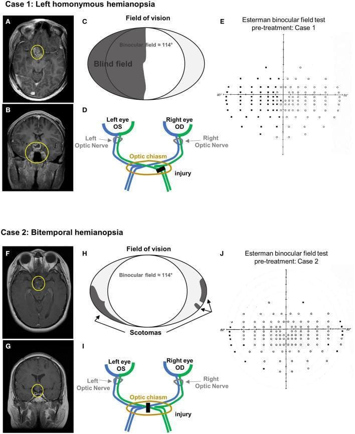 This composite educational image presents two clinical cases correlating neuroimaging findings with visual field defects. Case 1 (A-E) depicts left homonymous hemianopia. T1-weighted contrast-enhanced MRI in axial (A) and coronal (B) planes shows a heterogeneously enhancing mass in the suprasellar region (yellow circles), involving the optic chiasm and third ventricle floor. Schematic (C) and anatomical diagram (D) illustrate the corresponding lesion in the right optic tract and the resulting left hemifield blindness. The Esterman binocular field test (E) confirms significant unseen points (black dots) in the left visual field. Case 2 (F-J) depicts bitemporal hemianopia. MRI scans (F, G) reveal a residual suprasellar mass (yellow circles) inseparable from the hypothalamus and optic chiasm. The schematic (H) and optic pathway diagram (I) show a midline chiasmal injury, leading to peripheral scotomas. The Esterman test (J) demonstrates peripheral blind spots consistent with bitemporal vision loss. This comparison illustrates how specific anatomical injuries along the optic pathway correlate with distinct patterns of binocular visual impairment.
