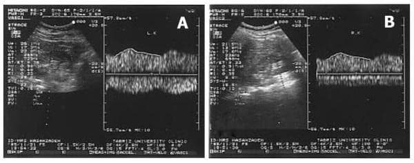 Two-panel diagnostic image featuring Doppler ultrasound spectral waveforms of the left (A) and right (B) renal arteries. Each panel includes a B-mode grayscale image of the renal parenchyma alongside its corresponding pulsed-wave Doppler trace. Both waveforms exhibit a classic parvus-tardus pattern, characterized by a dampened appearance with diminished peak systolic velocities (pulsus parvus) and a delayed, prolonged systolic upstroke or acceleration time (pulsus tardus). The systolic peaks are notably rounded rather than sharp, indicating significant proximal arterial obstruction or stenosis. These findings are clinically significant in the evaluation of secondary hypertension, suggesting hemodynamically significant stenosis upstream from the point of sampling, such as renal artery stenosis or aortic coarctation. Quantitative hemodynamic indices and velocity measurements are displayed on the left margin of each sonogram. This visual is intended for medical education regarding vascular sonography and diagnostic pathways for renovascular disease.