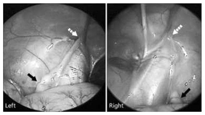 Laparoscopic intra-abdominal view demonstrating bilateral undescended testes (cryptorchidism). The composite clinical image shows two sub-panels, labeled 'Left' and 'Right', illustrating the findings during a diagnostic laparoscopy for impalpable testes. In both images, the intra-abdominal testis (indicated by solid black arrows) is positioned proximal to the internal inguinal ring (indicated by dashed white arrows). The 'Left' panel displays the ovoid morphology of the testis and the associated spermatic vessels. The 'Right' panel shows surgical instrumentation, likely a probe or grasper, used for mobilization or inspection of the cord structures. Key anatomical landmarks visible include the internal inguinal ring, the ductus deferens, and the testicular vessels. This visual is diagnostic for intra-abdominal cryptorchidism and serves as a surgical planning tool for orchidopexy, such as the Fowler-Stevens procedure. The images highlight the proximity of the gonads to the inguinal canal entry point within the retroperitoneal space.