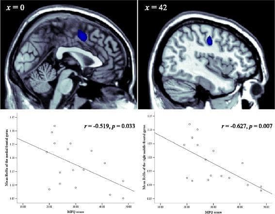 This composite educational graphic presents a neuroimaging correlation analysis in the context of Pediatric Bipolar Disorder (PBD) with depression. The top row features two sagittal MRI brain scans with blue highlighted regions of interest (ROIs) representing areas of significantly decreased Regional Homogeneity (ReHo). The scan at x = 0 (midline) highlights the medial frontal gyrus, while the scan at x = 42 identifies the right middle frontal gyrus. The bottom row displays corresponding scatter plots showing the relationship between Mood and Feelings Questionnaire (MFQ) scores on the x-axis and mean ReHo values on the y-axis. Both plots demonstrate a statistically significant negative correlation: the left plot (medial frontal gyrus) shows r = -0.519, p = 0.033, and the right plot (right middle frontal gyrus) shows r = -0.627, p = 0.007. This visualization illustrates the pathophysiology of depression in PBD patients, linking clinical symptom severity (MFQ scores) with specific functional neuroimaging biomarkers in the prefrontal cortex.