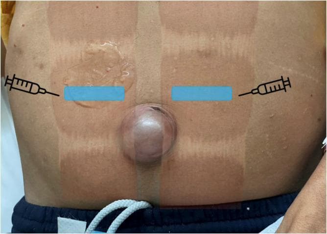 This clinical photograph displays a patient's abdomen in the supine position, featuring a large, prominent umbilical hernia. The hernia presents as a rounded, hemispherical protrusion several centimeters in diameter at the midline. The overlying skin appears tense and slightly erythematous, consistent with clinical incarceration. Superimposed on the image are educational annotations for a bilateral rectus sheath block (BRSB). Two horizontal blue boxes indicate the intended footprints for a linear ultrasound transducer, positioned transversely over the rectus abdominis muscles lateral to the umbilicus. Syringe icons illustrate the lateral-to-medial in-plane needle insertion technique. Also visible are vertical tan-colored markings on the skin following the abdominal wall anatomy, and ultrasound transmission gel applied to the right upper quadrant. The image serves as an educational guide for regional anesthesia landmarks and the clinical appearance of a complicated umbilical hernia.