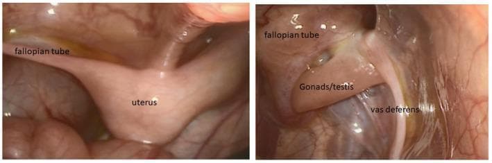 This diagnostic image consists of two labeled laparoscopy frames showcasing internal pelvic anatomy in a patient with ambiguous genitalia (46,XY DSD). The left panel illustrates a central, pear-shaped uterus-like structure with a fallopian tube extending laterally. The right panel displays complex internal reproductive anatomy, including a gonad identified as a testis, positioned adjacent to both a fallopian tube and a cord-like vas deferens. The presence of both Müllerian structures (uterus, fallopian tubes) and Wolffian structures (vas deferens) in an individual with testes is characteristic of persistent Müllerian duct syndrome or specific genetic variants affecting sex development, such as MAP3K1 mutations. The endoscopic view demonstrates the morphological appearance and spatial relationships of these ductal structures within the pelvic cavity, providing critical clinical evidence for surgical planning and diagnostic classification in pediatric endocrinology and urology.