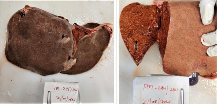 This clinical photograph displays a gross pathology specimen of a human liver obtained during a postmortem examination. The image is divided into two panels: the left shows the intact liver surface, while the right displays a transverse cut section of the hepatic parenchyma. The organ demonstrates prominent yellowish discoloration and a distinctive mottled appearance. This pattern, frequently referred to as a 'nutmeg liver,' is characterized by alternating dark reddish-brown areas, representing chronic venous congestion in the centrilobular regions, and paler yellowish areas, representing fatty change or normal parenchyma in the periportal regions. The specimen illustrates the macroscopic effects of chronic passive congestion, often secondary to congestive heart failure or toxic insults. The educational focus is on the gross recognition of hepatic congestion and jaundice, which are critical diagnostic indicators in forensic and clinical pathology.