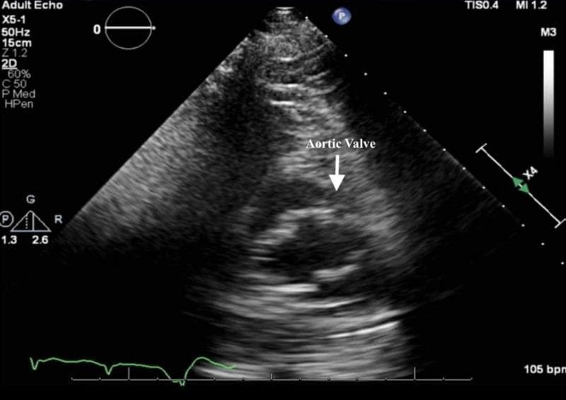 This diagnostic image is a transthoracic echocardiogram (TTE) in a parasternal short-axis view (PSAX) at the level of the aortic valve. The aortic valve is centrally positioned and identified with a white arrow and text label. Visually, the valve leaflets appear thickened and echo-dense, characteristic of calcific aortic stenosis. The surrounding structures include the right ventricular outflow tract (RVOT) and the left atrium, consistent with standard cardiac orientation in this view. Technical metadata displayed in the periphery includes a scanning frequency of 50Hz, a depth of 15cm, mechanical index (MI) of 1.2, and thermal index (TIS) of 0.4. An electrocardiogram (ECG) tracing at the bottom indicates a heart rate of 105 bpm. This visual is used in medical education to demonstrate the sonographic appearance of aortic stenosis and to teach the anatomical landmarks of the central cardiac base during non-invasive imaging.