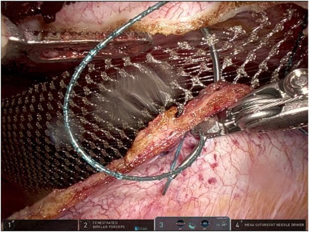 This intraoperative clinical photograph captures a key step in a robotic-assisted ventral hernia repair using the Da Vinci surgical system. The image demonstrates the closure of the ipsilateral posterior rectus sheath (PRS) following retromuscular mesh placement. A robotic needle driver (Mega SutureCut) is seen manipulating a 3-0 absorbable barbed suture, characterized by its thin, light blue appearance and integrated barbs for knotless fixation. The suture is being used in a continuous running fashion to approximate the edges of the PRS. Significantly, the suture line incorporates the edge of a synthetic macroporous mesh, which is visible as a grid-like filament structure positioned in the retrorectus space. This technique secures the mesh at the cranial and caudal borders to prevent migration while simultaneously restoring the peritoneal barrier. The surrounding tissue shows characteristic surgical anatomy, including the vascularized surface of the posterior sheath and the edge of the rectus muscle. This visual is intended for surgical education regarding robotic abdominal wall reconstruction and mesh fixation techniques.
