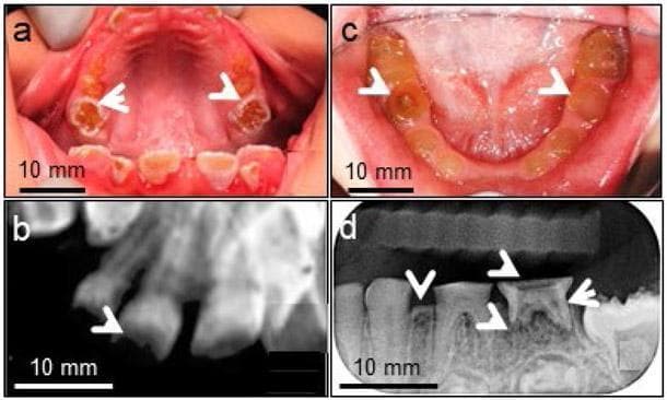 A multi-panel figure displaying clinical and radiographic findings of Dentinogenesis Imperfecta Type II (DGI-II). (a, c) Intraoral clinical photographs of the primary and early mixed dentition show hallmark features including opalescent, yellow-brown discoloration and a translucent appearance of the teeth. Severe occlusal attrition (white arrowheads) is visible, with significant loss of crown height down to the gingival level in some areas. (b, d) Dental radiographs demonstrate the structural internal consequences of the disease. Key findings include significantly reduced dental mineral density, thin dentine layers, and rapid enamel loss. The pulp chambers and root canals appear constricted or obliterated (decreased pulp space). White arrowheads in panel (d) highlight periapical radiolucencies consistent with periapical abscesses, a common complication arising from early pulp exposure due to rapid wear. These images illustrate the phenotypic manifestations of DSPP gene mutations affecting dentinogenesis.