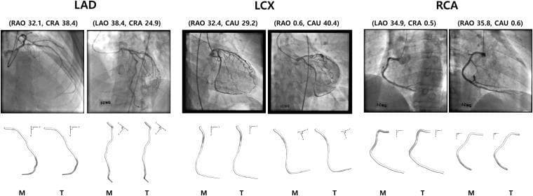 This diagnostic image and anatomical diagram set illustrates 3-D reconstructions of the human coronary arteries derived from 2-D coronary angiograms. The content is organized into three sections covering the Left Anterior Descending (LAD) artery, the Left Circumflex (LCX) artery, and the Right Coronary Artery (RCA). Each section displays two angiographic views captured at different projection angles, labeled with RAO/LAO (Right/Left Anterior Oblique) and CRA/CAU (Cranial/Caudal) coordinates. Below the radiographs are 3-D centerline models reconstructed using two computational methods: Manual matching (M) of landmark points and automated Template matching (T). The diagrams highlight the vascular morphology, including vessel curvature and tapering, demonstrating the precision of computerized reconstruction in interventional cardiology. This material is designed for advanced medical education in radiology and cardiology, focusing on the application of deep learning and geometric back-projection to overcome vessel foreshortening in diagnostic imaging.