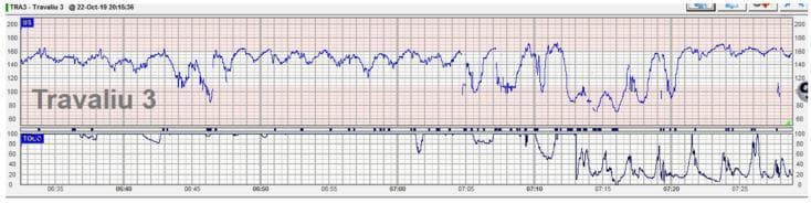 This diagnostic image is a Cardiotocograph (CTG) trace, representing electronic fetal monitoring during labor. The upper panel displays the Fetal Heart Rate (FHR) in beats per minute (bpm), and the lower panel represents uterine activity or contractions via tocodynamometry (TOCO). The FHR tracing initially shows a baseline rate between 140-160 bpm with moderate variability and intermittent variable decelerations. A clinically significant event occurs around time marker 07:05, characterized by a sudden, prolonged deceleration where the fetal heart rate drops below 100 bpm and remains depressed for several minutes, indicating potential fetal distress. Simultaneously, the lower TOCO trace shows an increase in uterine contraction frequency and intensity, reaching peaks of nearly 100 units. This specific pattern is classically associated with umbilical cord prolapse or severe cord compression. This visual material is used in obstetrics and gynecology to teach intrapartum fetal assessment, identification of non-reassuring heart rate patterns, and emergency obstetric management.