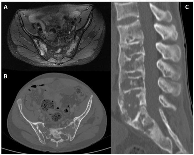 Multi-modal diagnostic imaging of the lumbosacral region in a 31-year-old male with sickle cell disease. (A) Axial fat-saturated proton density (PD) MRI shows bilateral sacroiliac joints with prominent, high-signal intensity areas indicative of bone marrow edema and surrounding soft tissue inflammation. (B) Axial CT slice of the pelvis demonstrates thinning of the iliac cortical bone and mottled medullary density. (C) Sagittal lumbar spine CT reconstruction reveals extensive skeletal changes including widened medullary spaces, thinning of the cortical bone, and characteristic 'fish-mouth' or 'H-shaped' vertebral deformities due to central endplate depressions. These findings collectively illustrate musculoskeletal complications of sickle cell disease, specifically bone marrow hyperplasia and secondary ischemic changes (infarctions) leading to structural vertebral remodeling and sacroiliac joint involvement.