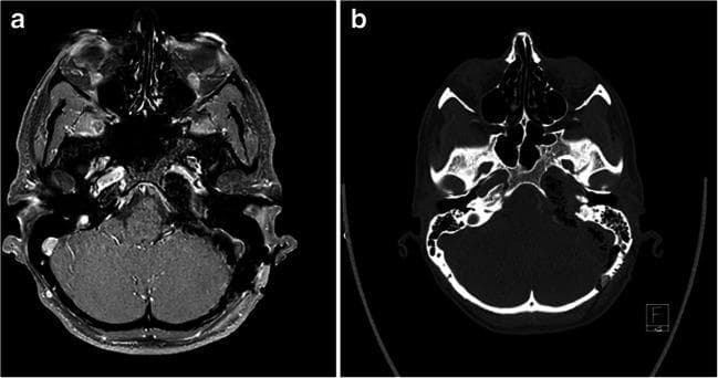 This composite figure presents postoperative neuroimaging in two modalities: (a) an axial T1-weighted MRI with Gadolinium contrast (Gd+) subtraction series and (b) a non-contrast axial CT scan. The images illustrate the result of a retrosigmoid intradural inframeatal petrosectomy (RESIP) for a grade II chondrosarcoma of the left petrous apex. In image (a), the MRI subtraction technique highlights the absence of significant pathological enhancement, confirming near-total resection of the tumor with high soft-tissue resolution of the brain parenchyma and cranial nerves. In image (b), the axial CT scan provides a detailed view of the bony anatomy of the skull base, showing the surgical defect in the left petrous bone and the extent of bone removal required to reach the petroclival space. Comparison between the two highlights the CT's superior visualization of osseous changes and the MRI's effectiveness in assessing residual soft-tissue tumor volume and inflammatory changes. The imaging confirms successful decompression and surgical management of a complex skull base lesion.