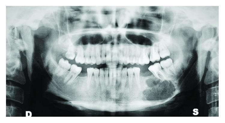 This diagnostic image is a panoramic radiograph (orthopantomogram) of the maxillofacial region. The primary finding is a large, well-circumscribed, mixed radiolucent-radiopaque lesion located in the left mandibular body, specifically extending from the premolar region to the molar region. The lesion exhibits characteristic features of an ossifying fibroma, including a well-defined sclerotic border and internal 'ground-glass' or granular radiopacity. There is significant downward expansion and thinning of the inferior border of the mandible. The lesion is in close proximity to the roots of the mandibular left second premolar and first and second molars, causing apparent root displacement and impingement on the alveolar bone. The rest of the dentition is visible, alongside typical anatomical landmarks including the maxillary sinuses, nasal cavity, and bilateral temporomandibular joints. This image is used in dental and maxillofacial surgery education to illustrate the radiographic presentation of benign fibro-osseous lesions and their impact on surrounding mandibular architecture.