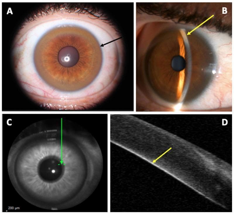 This composite educational graphic illustrates clinical and diagnostic findings of the Kayser–Fleischer ring (KFR), a pathognomonic sign of Wilson disease. Panel A is a clinical photograph from a slit-lamp examination showing a diffuse, circumferential golden-brown pigment ring (black arrow) in the corneal limbic area. Panel B utilizes a fine-slit lamp beam to demonstrate the precise localization of copper deposits at the posterior aspect of the cornea (yellow arrow). Panel C provides a localized infrared corneal B-scan view, while Panel D presents an Anterior Segment Optical Coherence Tomography (AS-OCT) cross-sectional image. The AS-OCT scan reveals a distinct, linear hyper-reflective layer at the level of the Descemet’s membrane (yellow arrow), corresponding exactly to the clinical site of copper deposition. This visual comparison highlights how diagnostic imaging can verify clinical observations of ocular copper accumulation in patients with copper metabolism disorders.