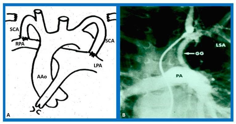 This composite educational image illustrates the concept and clinical application of a Blalock-Taussig (BT) shunt for congenital heart disease. Panel A is a historical anatomical diagram showing the surgical connection between the subclavian arteries (SCA) and the right and left pulmonary arteries (RPA, LPA) arising from the ascending aorta (AAo). This represents the classic palliative procedure intended to increase pulmonary blood flow. Panel B is a cineangiographic frame demonstrating a modified Blalock-Taussig anastomosis in a clinical setting. It shows a Gore-Tex graft (GG) connecting the left subclavian artery (LSA) to the pulmonary artery (PA). The angiography reveals a patent, wide-open anastomosis with robust contrast opacification of the pulmonary artery, confirming successful systemic-to-pulmonary shunting. This visual material is used to teach surgical management of cyanotic heart defects, such as Tetralogy of Fallot or pulmonary atresia, where increasing pulmonary perfusion is critical for patient stabilization.