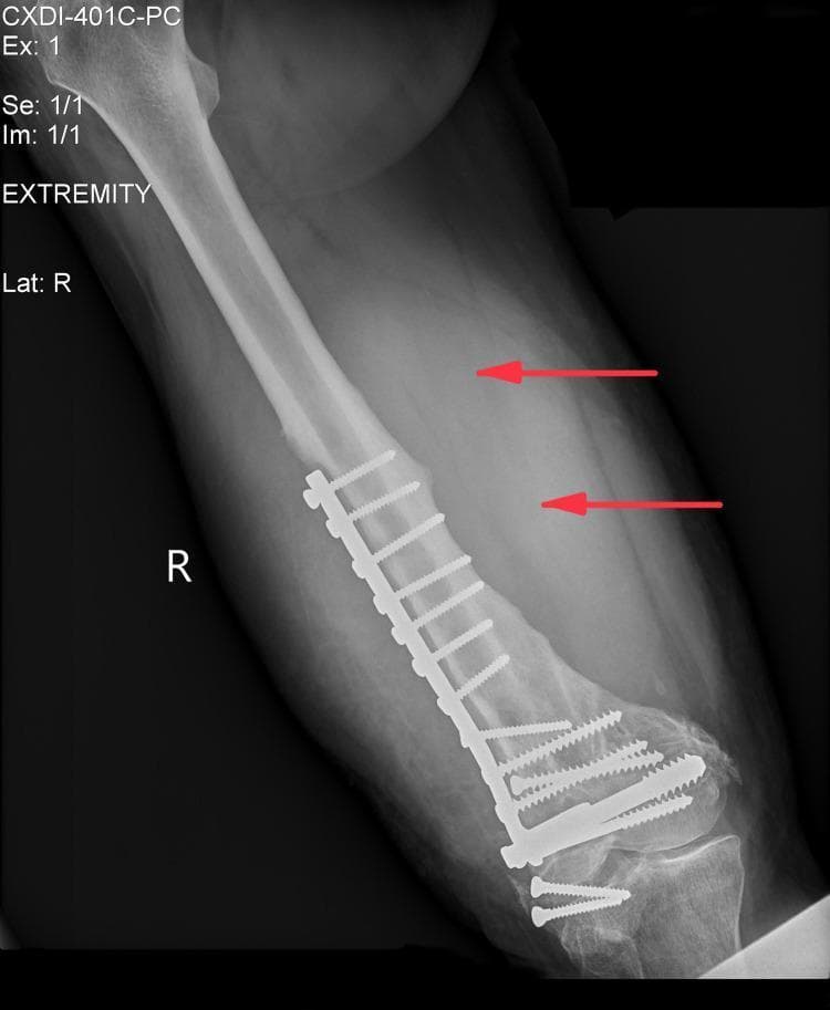 An anteroposterior (AP) view X-ray of the right distal femur demonstrating internal fixation and surrounding pathology. A radiopaque dynamic compression plate (DCP) is visible on the lateral aspect of the femoral shaft, secured by multiple orthopedic screws. In the adjacent soft tissues, there is a large, ill-defined area of increased radiolucency (hyperlucency) indicated by two red horizontal arrows, suggesting a significant soft tissue mass, fluid collection, or abscess. The distal femur shows signs of previous fracture healing or remodeling around the hardware. This diagnostic image is significant for evaluating post-surgical complications, such as infection or tumor formation (e.g., plasmablastic lymphoma as suggested by context) in the setting of chronic orthopedic implants.
