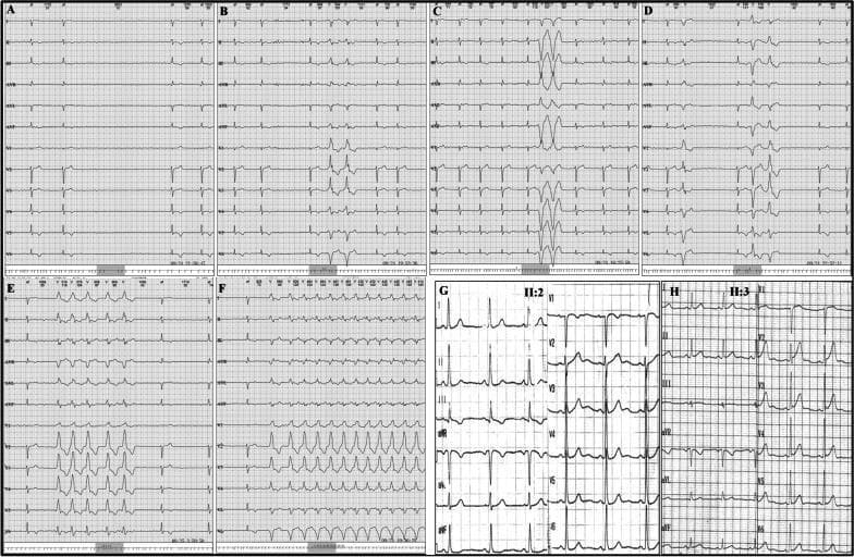 This composite figure presents 12-lead electrocardiograms (ECGs) from members of a family, illustrating various cardiac arrhythmias. Panels A through F display findings from a single patient (proband II:1) with cardiomyopathic changes. Panels A and B show intermittent premature ventricular complexes (PVCs). Panels C and D demonstrate paired PVCs (couplets), while panels E and F capture episodes of non-sustained and sustained ventricular tachycardia (VT), characterized by wide QRS complexes and rapid rates. The background rhythm in these panels shows signs of atrial fibrillation with long RR intervals and low voltage in the limb leads. In contrast, panels G and H represent familial members II:2 and II:3, respectively. Panel G shows a largely normal sinus rhythm with standard R-wave progression in the precordial leads. Panel H shows a regular rhythm with mild T-wave flattening across multiple leads. The figure serves as a clinical comparison between severe arrhythmic manifestations (VT, PVCs) in a proband and the relatively normal ECG findings in first-degree relatives within the context of inherited cardiomyopathy.