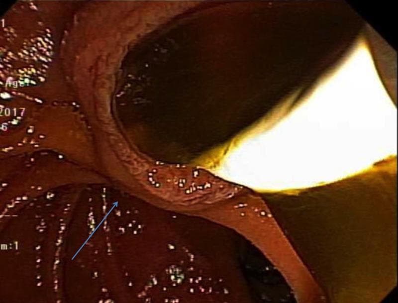 This clinical photograph displays an endoscopic view during an Endoscopic Retrograde Cholangiopancreatography (ERCP). The image captures the interior of the common bile duct (CBD), which appears dilated and lined with hyperemic, reddish-brown mucosa suggestive of inflammatory changes. Within the lumen, there is an accumulation of thick, dark, viscous mucus causing obstruction. A bright, white, opaque inflated extraction balloon is visualized being used to retract and sweep the mucinous material from the duct. A blue arrow indicates the wall of the common bile duct. This visual demonstrates the management of biliary obstruction caused by mucin-producing pathologies, such as intraductal papillary mucinous neoplasms of the bile duct (IPMN-B). The procedural context illustrates the use of balloon sweeps to clear the biliary tree and alleviate jaundice or cholangitis secondary to mechanical occlusion by mucin.