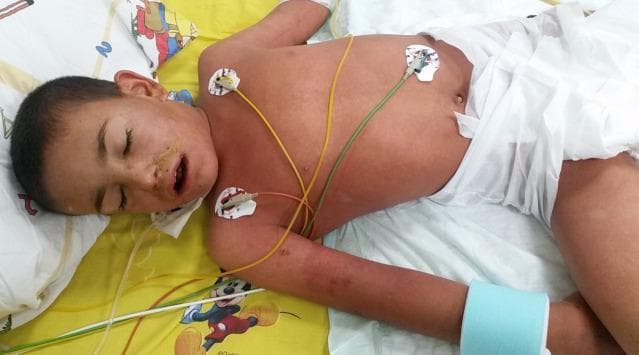 This clinical photograph displays a pediatric patient in an intensive care setting presenting with generalized erythema. The patient exhibits a diffuse, confluent macular rash characterized by intense redness across the face, torso, abdomen, and upper extremities. Notable clinical signs include bilateral conjunctival suffusion and crusting/secretions around the nasal and oral orifices. The image documents several medical interventions and monitoring devices, including a nasogastric or feeding tube, multiple ECG adhesive electrodes on the chest for continuous cardiac monitoring, and a soft blue safety restraint on the left wrist. The clinical context suggests a systemic inflammatory or infectious process, such as severe leptospirosis or toxic shock syndrome (STSS). This photograph is an educational example of multisystem disease manifestation in a pediatric patient, emphasizing the dermatological and clinical findings associated with severe systemic infections and the requirements for critical care monitoring.