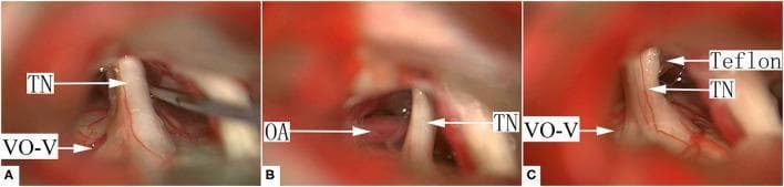 Microvascular decompression (MVD) for trigeminal neuralgia involving venous offending vessels (VO-VREZ). This three-panel intraoperative clinical photograph (A, B, C) demonstrates the neurovascular relationship at the cerebellopontine angle. (A) Shows the trigeminal nerve (TN) in direct contact with a venous offending vessel on the ventral side of the root entrance/exit zone (VO-V), where the vein is largely covered by the nerve root. A surgical dissector is visible manipulating the tissue. (B) Reveals a suspected offending artery (OA) situated behind the TN, contributing to the neurovascular conflict. (C) Illustrates the surgical resolution where shredded Teflon interposition material is placed between the nerve root and the offending vessels. This mechanical decompression separates the TN from the VO-V and OA to relieve nerve compression. The series highlights surgical management of Group II, Type A venous compression, showcasing the transition from initial neurovascular contact to the final decompression with synthetic material.