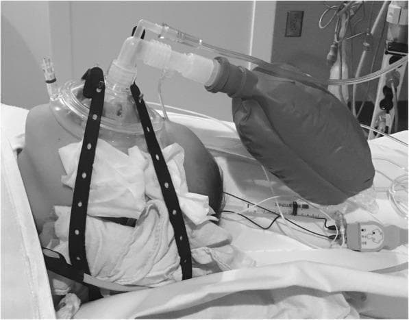 This clinical photograph illustrates a pediatric patient under procedural sedation or general anesthesia, managed with a specialized respiratory circuit. A clear, contoured anesthesia face mask is positioned over the child's nose and mouth, secured firmly by a multi-holed black rubber head strap (Spider strap) to maintain an airtight seal for Continuous Positive Airway Pressure (CPAP). The mask is connected to a Jackson-Rees circuit, a modification of the Mapleson F system, characterized by the visible reservoir bag and fresh gas flow tubing. Key components include an elbow connector at the mask apex, a wide-bore corrugated tube leading to the reservoir bag, and a thin pressure-monitoring line or supplemental oxygen tubing. White gauze padding is placed under the straps near the neck and cheeks to prevent pressure-related skin injury. In the immediate vicinity, a syringe and a medical sensor (likely a pulse oximetry or CO2 monitoring cable) are visible on the sterile field. This setup is clinically used to provide airway support and maintain functional residual capacity (FRC) during radiological procedures or surgery.