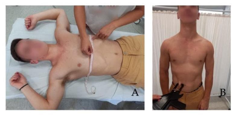 This clinical procedural image consists of two panels demonstrating anthropometric measurement techniques for assessing body composition and respiratory mechanics. Panel A (left) shows a subject in a supine position on an examination table with arms abducted to 90 degrees. A clinician is using a flexible, non-elastic measuring tape to determine the thorax circumference. The tape is positioned horizontally at the level of the xiphoid process, captured during maximum inspiration to evaluate chest expansion. Panel B (right) depicts a subject standing in an erect, neutral posture while a clinician performs a skinfold thickness test on the abdomen. A specialized skinfold caliper is used to pinch and measure the subcutaneous fat layer near the umbilical region. These procedures are common in physical therapy, sports medicine, and nutritional assessments to monitor physiological changes, calculate body density, or assess respiratory function. The images emphasize proper anatomical landmarking—the xiphoid process for thoracic girth and the abdominal wall for skinfold measurement—essential for clinical reliability.