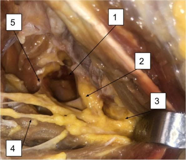 This clinical photograph displays a posterior surgical dissection of the human shoulder, highlighting the neurovascular anatomy of the quadrangular space (1). The primary structure shown is the axillary nerve (2), which is visualized traversing the quadrangular space. The image demonstrates the branching patterns of the axillary nerve, specifically identifying the muscular branch to the deltoid muscle (3) and the muscular branch to the teres minor muscle (4). Additionally, an articular branch of the axillary nerve (5) is visible, showing its course toward the glenohumeral joint. The dissection reveals the spatial relationships between these neural structures and the surrounding musculature, including the deltoid and teres minor. This anatomical view is essential for understanding the distribution of the axillary nerve and its potential sites of compression or injury during posterior surgical approaches to the shoulder or in quadrangular space syndrome.