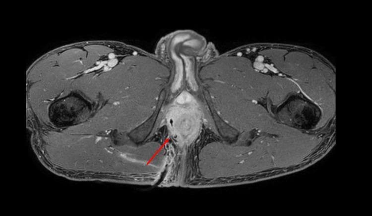 This diagnostic image is an axial MRI of the male pelvic region, showing the anatomy at the level of the anal canal and ischioanal fossa. The scan reveals a post-procedural state following the drainage of a complex perianal abscess. A red arrow points to a hypointense, linear tubular structure representing a percutaneous drain coursing through the right ischioanal fossa toward the central perianal area. The surrounding tissue shows a reduction in high-signal inflammatory fluid compared to a pre-drainage state, indicating abscess involution. Key visible structures include the central anal canal, the prostate gland located anteriorly, the external genitalia, and the bilateral gluteus maximus muscles and ischioanal fat. The image demonstrates the clinical application of interventional radiology in managing pelvic infections and the use of MRI for monitoring treatment response in complex fistulating disease.