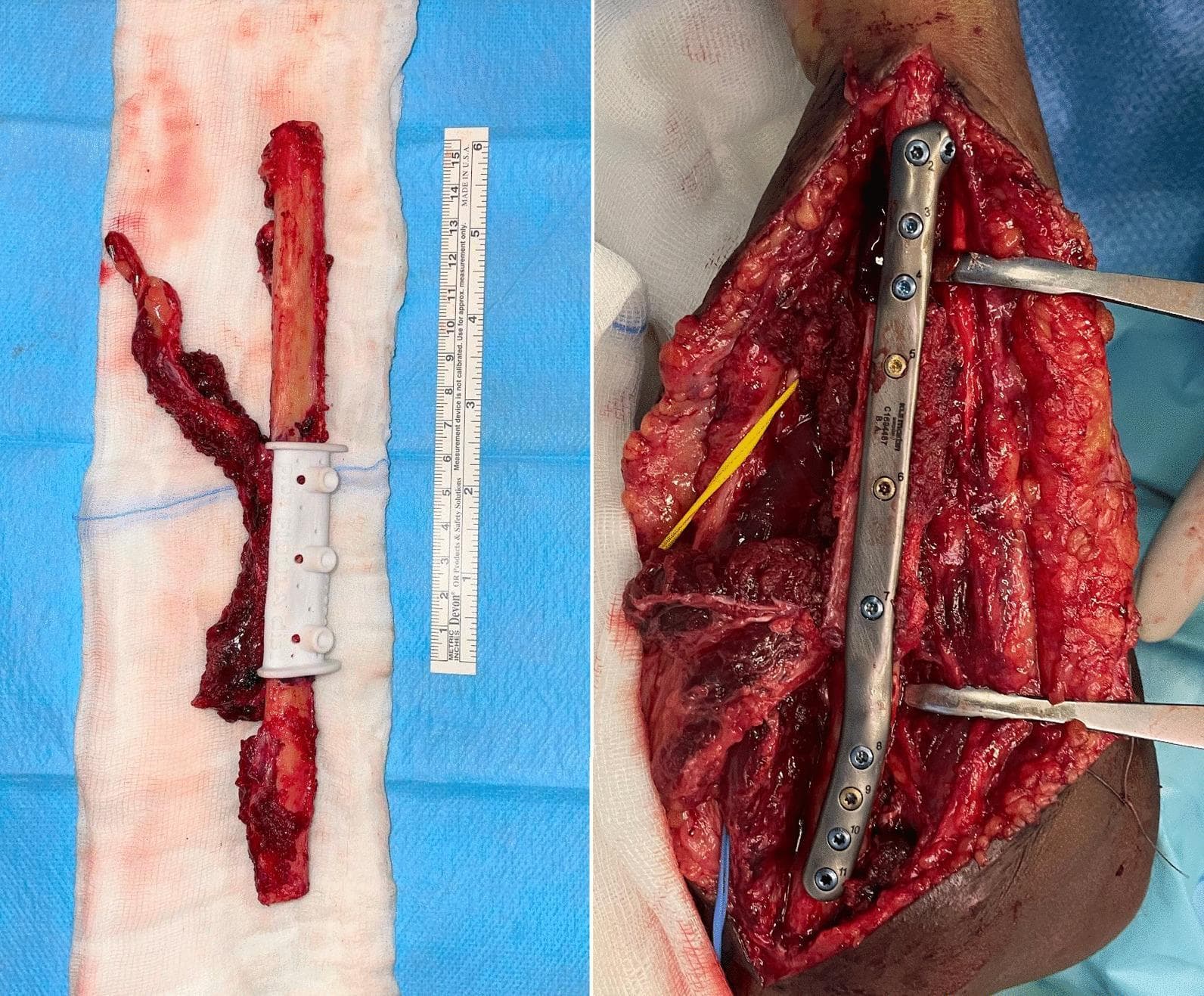 This dual-panel clinical photograph illustrates a microvascular free fibular flap procedure for orthopedic reconstruction. Panel A (left) displays the harvested fibular graft specimen on a sterile drape. It features a vascularized bone segment with an attached vascular pedicle (peroneal artery and venae comitantes) and a white, 3D-printed patient-specific cutting guide fitted centrally to facilitate precise osteotomies. A surgical ruler is positioned alongside for scale. Panel B (right) shows the intraoperative recipient site, likely the forearm, where the fibular flap has been inset to bridge a diaphyseal bone defect. The graft is rigidly stabilized using a long, numbered titanium locking compression plate and multiple screws. Retractors are in place to expose the surgical field, which shows evidence of revascularization and soft tissue integration. This image demonstrates the application of Virtual Surgical Planning (VSP) and custom instrumentation in managing complex nonunions or significant bone loss through vascularized bone grafting.