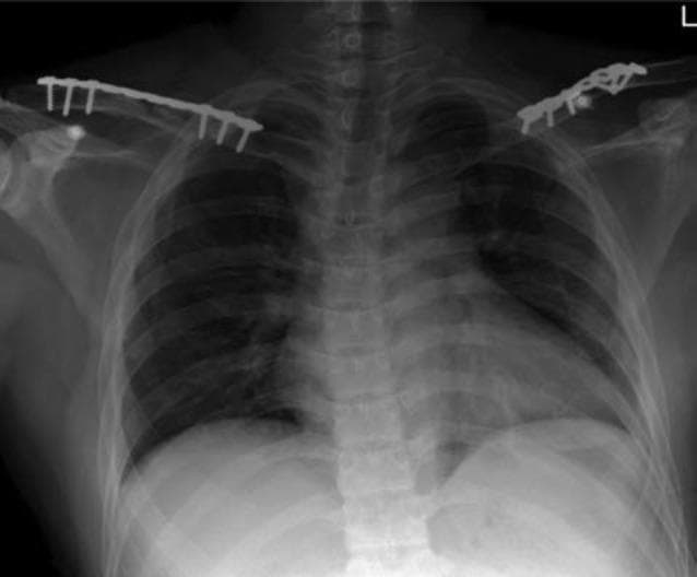 This diagnostic image is an anteroposterior (AP) chest and shoulder radiograph showing postoperative results of bilateral clavicle fracture fixation. The primary visible anatomy includes the thorax, ribs, clavicles, and proximal humeri. The central focus is the presence of surgical hardware: bilateral 3.5mm metallic reconstruction plates secured along the superior aspect of both the left and right clavicles. These radiopaque plates are fixed to the bone using multiple bicortical screws to bridge the fracture sites. The skeletal alignment of the shoulder girdle appears restored. The underlying lung fields are clear, the cardiomediastinal silhouette is within normal limits, and the trachea is midline. This image serves as a clinical example of orthopedic internal fixation for trauma management of bilateral upper extremity injuries.
