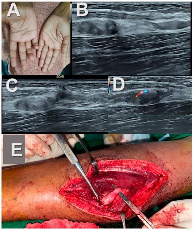 This composite educational image illustrates the clinical, sonographic, and surgical findings of ulnar nerve stump neuromas following traumatic transection.
Panel A (Clinical Photograph): Demonstrates a 'claw hand' deformity involving the right 4th and 5th digits, a classic sign of distal ulnar nerve palsy.
Panels B and C (Diagnostic Ultrasound): High-resolution longitudinal B-mode ultrasound images showing complete nerve transection. The proximal and distal nerve ends exhibit bulbous, hypoechoic, mass-like enlargements consistent with stump neuromas. A gap between the nerve ends is filled with hyperechoic adipose tissue in the intermuscular plane.
Panel D (Power Doppler): Shows mild internal vascularity within the hypoechoic neuroma, represented by color flow signals.
Panel E (Intra-operative Photograph): A surgical view of the mid-forearm displaying the bulbous, pale neural tissue during excision or repair.
This sequence highlights the diagnostic pathway from physical examination to radiologic confirmation and surgical management of traumatic peripheral nerve injuries. Key concepts include post-traumatic neuroma formation, sonographic assessment of nerve continuity, and the 'split fat sign' in intermuscular neural lesions.