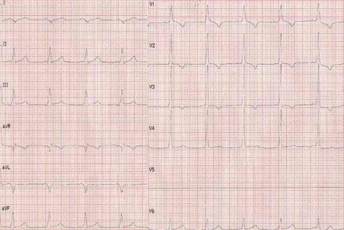 This diagnostic image is a 12-lead electrocardiogram (ECG) recorded at standard paper speed and gain, demonstrating the classic findings of Wolff-Parkinson-White (WPW) syndrome. The tracing reveals a sinus rhythm with a pathologically shortened PR interval (less than 120 ms). A defining feature is the presence of delta waves, characterized by a visible slurring or slow upstroke at the beginning of the QRS complex, most notably prominent in leads II, III, aVF, and the precordial leads V2-V6. This pre-excitation pattern results in a secondary widening of the QRS complex. The QRS morphology in lead V1 shows a predominantly positive deflection (R wave), which may suggest the location of the accessory pathway. The ECG illustrates the classic triad of WPW: a short PR interval, a delta wave, and QRS widening, which are critical for the diagnosis of ventricular pre-excitation in a clinical setting involving supraventricular tachycardia.
