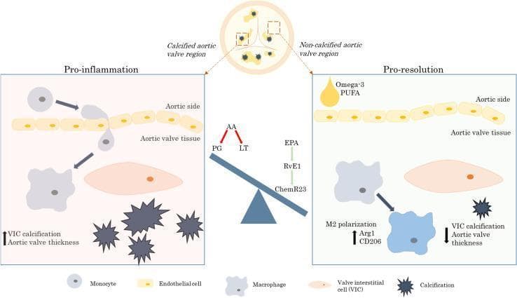This pathophysiology diagram illustrates the cellular and molecular mechanisms of aortic valve stenosis, specifically contrasting 'Pro-inflammation' and 'Pro-resolution' pathways. The central overview shows a cross-section of an aortic valve with highlighted calcified and non-calcified regions. In the 'Pro-inflammation' panel, the diagram depicts monocyte transendothelial migration from the aortic side into the valve tissue, where they differentiate into macrophages that interact with valvular interstitial cells (VICs). This state is characterized by increased VIC calcification (shown as dark starburst shapes) and increased aortic valve thickness, driven by arachidonic acid (AA) metabolites like prostaglandins (PG) and leukotrienes (LT). Conversely, the 'Pro-resolution' panel demonstrates the therapeutic signaling axis involving Omega-3 polyunsaturated fatty acids (PUFA), eicosapentaenoic acid (EPA), resolvin E1 (RvE1), and the ChemR23 receptor. This axis promotes M2 macrophage polarization (marked by Arg1 and CD206), leading to a reduction in VIC calcification and valve thickness. The visual comparison highlights the role of specialized pro-resolving mediators in mitigating valvular disease progression by shifting the balance away from inflammatory lipid mediators.