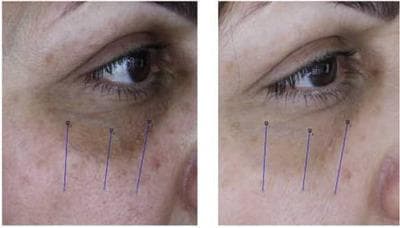 This clinical photograph presents a side-by-side 'before' and 'after' comparison of the periorbital and malar regions in a patient with pigmented dark under-eye circles (DUC). The 'before' image (left) shows significant infraorbital hyperpigmentation with a dark, mottled brown appearance extending from the medial canthus to the lateral periorbital area. There is visible skin texture irregularity and prominent fine lines in the lower eyelid and upper cheek regions. The 'after' image (right) demonstrates the clinical outcome following carboxytherapy, showing a marked reduction in pigmentation intensity and a more uniform skin tone. The treated area exhibits a smoother texture with diminished visibility of pores and fine wrinkles. Blue vertical lines are overlaid for measurement reference, likely marking the lateral, middle, and medial zones for quantitative ΔE (color change) analysis. This comparison illustrates the efficacy of carboxytherapy in managing periorbital hyperpigmentation and improving overall skin quality in Fitzpatrick skin type III individuals.