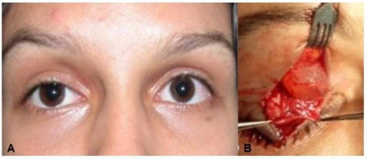 This composite medical image presents clinical and intraoperative views of a case involving blepharoptosis and an eyelid lesion. Figure A is a clinical photograph of a 17-year-old patient demonstrating unilateral ptosis of the right upper eyelid. The eyelid margin is notably lower than the left, covering the superior portion of the iris. Figure B provides an intraoperative surgical view of the same patient during ptosis repair. It reveals a translucent, round cystic lesion approximately 1 cm in diameter containing clear liquid, situated within the fibers of the levator palpebrae superioris muscle. The cyst appears well-circumscribed without obvious adherence to surrounding orbital tissues. These findings are clinically relevant to the differential diagnosis of congenital ptosis, identifying an apocrine hidrocystoma as a mechanical cause for the eyelid drooping. The image is suitable for medical education in ophthalmology, oculoplastics, and pathology, illustrating how a deep-seated eyelid cyst can manifest as eyelid malposition.